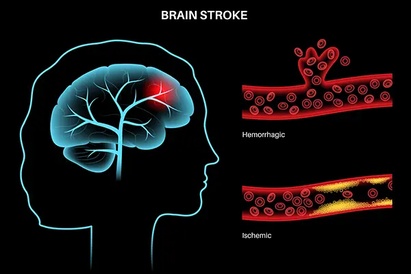 brain-stroke-management-treatment-in-lucknow